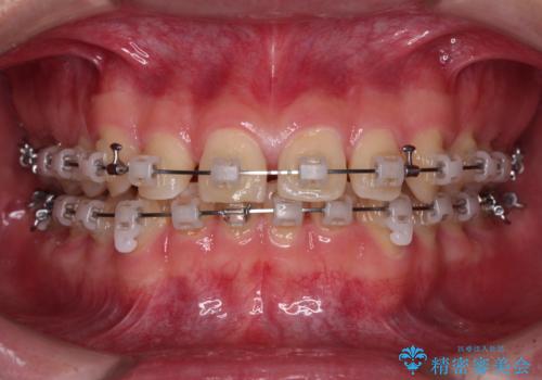 隙間とデコボコを治したい ワイヤー装置による矯正治療の治療中