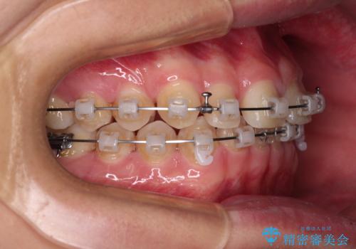 隙間とデコボコを治したい ワイヤー装置による矯正治療の治療中