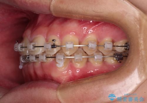 隙間とデコボコを治したい ワイヤー装置による矯正治療の治療中