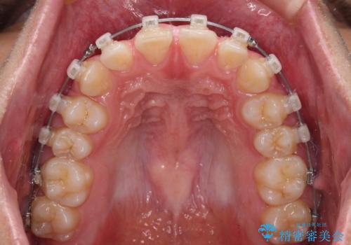 隙間とデコボコを治したい ワイヤー装置による矯正治療の治療中