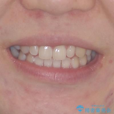 隙間の空いた歯列とボロボロの乳歯　インプラント治療と矯正治療の治療前（顔貌）