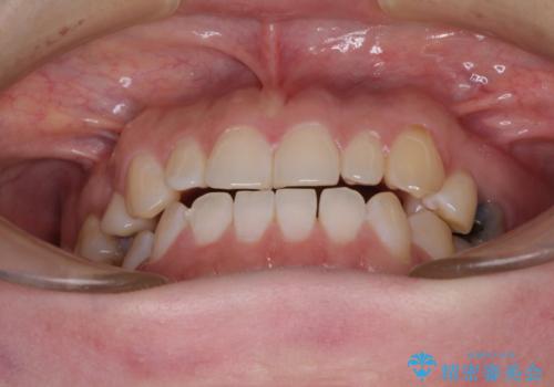 隙間の空いた歯列とボロボロの乳歯　インプラント治療と矯正治療の治療前