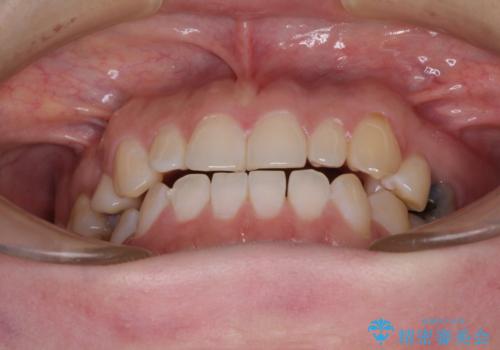 隙間の空いた歯列とボロボロの乳歯 インプラント治療と矯正治療の治療前