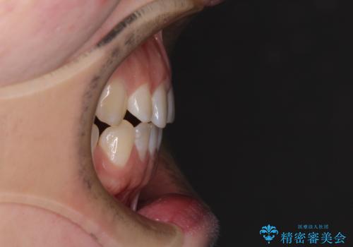 隙間の空いた歯列とボロボロの乳歯 インプラント治療と矯正治療の治療前