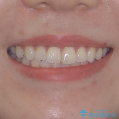 隙間が空いてデコボコした前歯を治したい ワイヤー装置による矯正治療の治療後(顔貌)