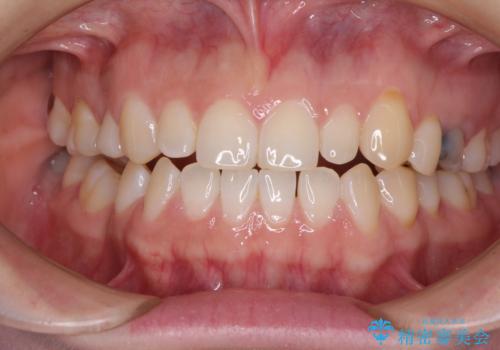 隙間の空いた歯列とボロボロの乳歯　インプラント治療と矯正治療の治療前