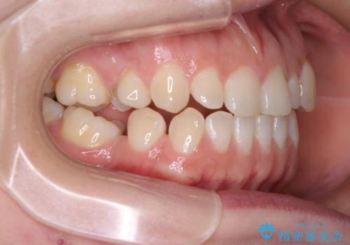 隙間の空いた歯列とボロボロの乳歯 インプラント治療と矯正治療の治療前