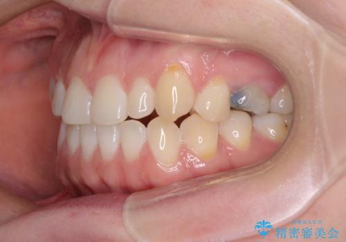 隙間の空いた歯列とボロボロの乳歯 インプラント治療と矯正治療の治療前