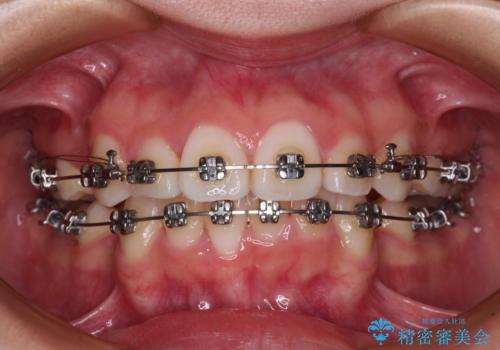 前歯のデコボコとクロスバイトを治したい ワイヤー装置による抜歯矯正の治療中