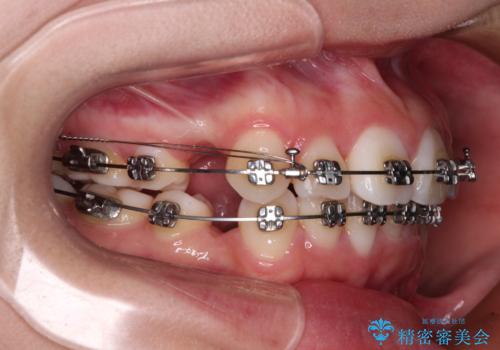 前歯のデコボコとクロスバイトを治したい ワイヤー装置による抜歯矯正の治療中