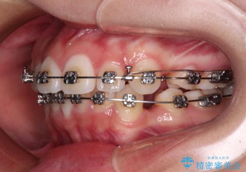 前歯のデコボコとクロスバイトを治したい ワイヤー装置による抜歯矯正の治療中