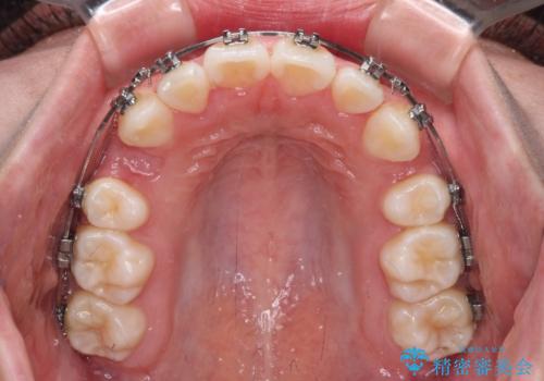 前歯のデコボコとクロスバイトを治したい　ワイヤー装置による抜歯矯正の治療中