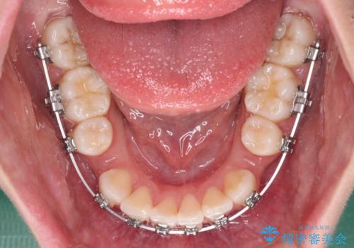 前歯のデコボコとクロスバイトを治したい　ワイヤー装置による抜歯矯正の治療中