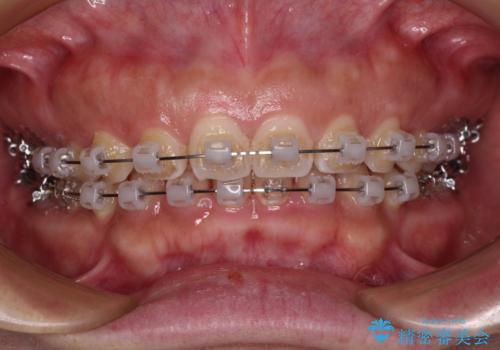 【モニター】ディープバイトを治す ワイヤー装置による矯正治療の治療中