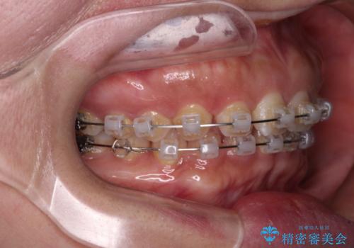【モニター】ディープバイトを治す ワイヤー装置による矯正治療の治療中
