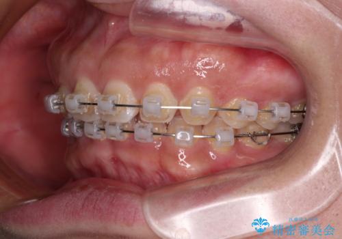 【モニター】ディープバイトを治す ワイヤー装置による矯正治療の治療中