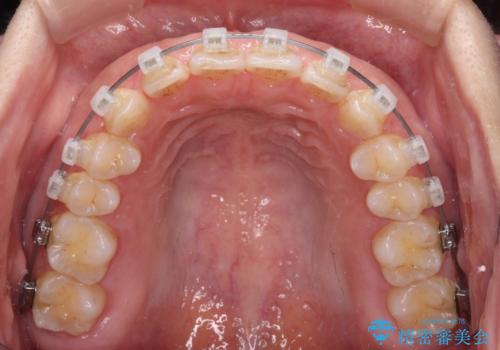 【モニター】ディープバイトを治す ワイヤー装置による矯正治療の治療中