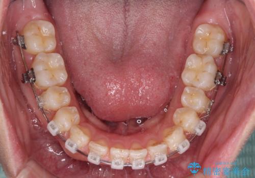 【モニター】ディープバイトを治す ワイヤー装置による矯正治療の治療中