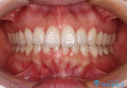 矯正治療の後戻り インビザライン・ライトでの再矯正の症例 治療前