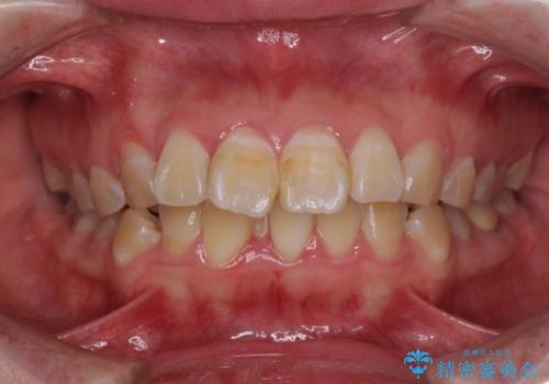 抜歯矯正で唇を閉じやすく ワイヤー矯正の症例 治療前