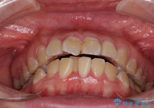 抜歯矯正で唇を閉じやすく ワイヤー矯正の治療前