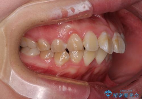 抜歯矯正で唇を閉じやすく ワイヤー矯正の治療前