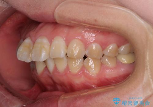 抜歯矯正で唇を閉じやすく ワイヤー矯正の治療前