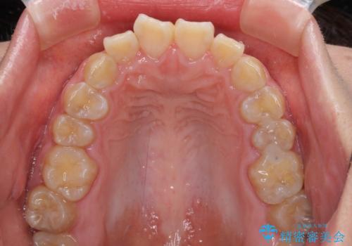 抜歯矯正で唇を閉じやすく ワイヤー矯正の治療前