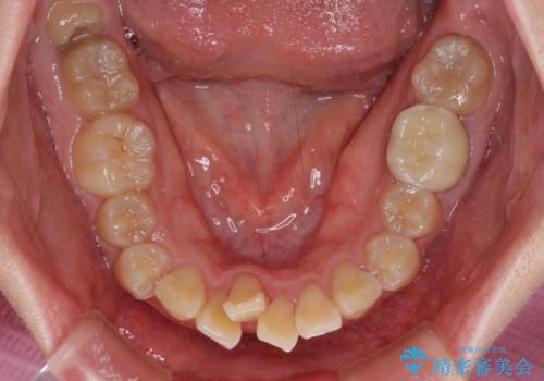 抜歯矯正で唇を閉じやすく ワイヤー矯正の治療前