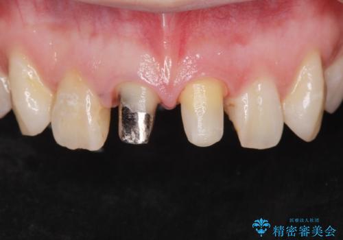前歯の色が気になる。の治療中