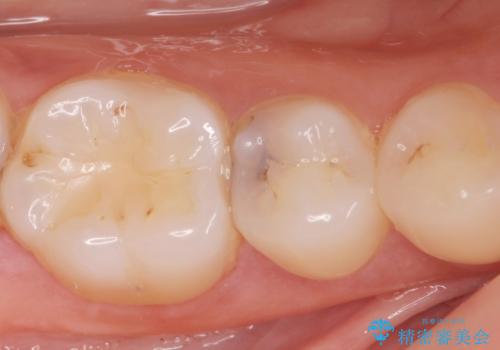 [e-maxインレー] 矯正治療前の虫歯治療の治療前