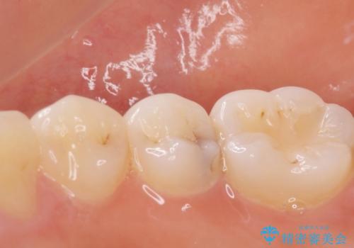 [e-maxインレー] 矯正治療前の虫歯治療の治療前