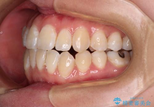 外に飛び出して磨きにくい奥歯と上下前歯の隙間　インビザラインによる矯正治療の治療中
