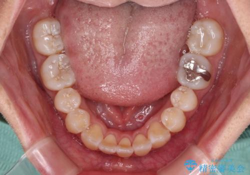 外に飛び出して磨きにくい奥歯と上下前歯の隙間　インビザラインによる矯正治療の治療中