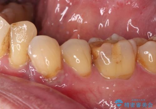 根元で折れてしまった歯を何とか保存する　部分矯正と補綴治療の症例 治療前