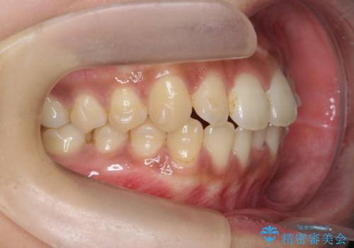 [ 歯を抜かないマウスピース矯正 ]  不揃いの目立つ前歯をきれいにしたいの治療中