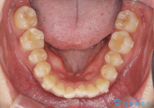 [ 歯を抜かないマウスピース矯正 ]  不揃いの目立つ前歯をきれいにしたいの治療中
