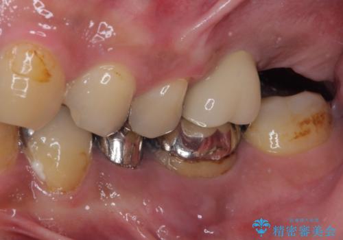 目立つ金属をすべてセラミックに 全顎的メタルフリー治療の治療前