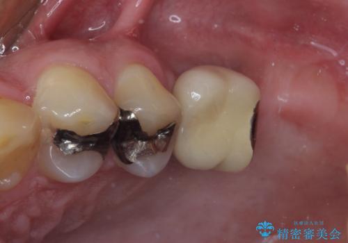目立つ金属をすべてセラミックに 全顎的メタルフリー治療の治療前