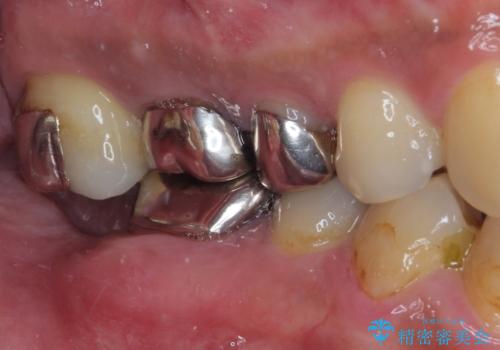 目立つ金属をすべてセラミックに 全顎的メタルフリー治療の治療前
