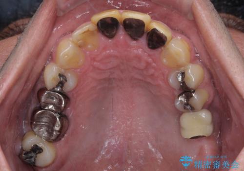 目立つ金属をすべてセラミックに 全顎的メタルフリー治療の治療前