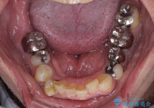 目立つ金属をすべてセラミックに 全顎的メタルフリー治療の治療前