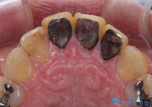 目立つ金属をすべてセラミックに 全顎的メタルフリー治療の治療前