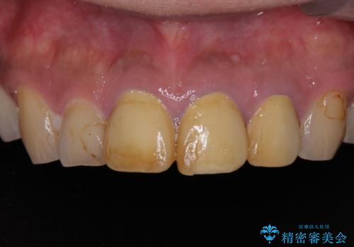 目立つ金属をすべてセラミックに 全顎的メタルフリー治療の治療前