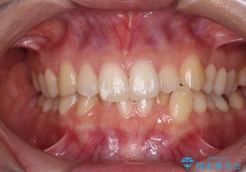 【モニター】前歯のデコボコとクロスバイト　インビザラインによる矯正治療の治療前