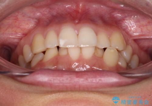 【モニター】前歯のデコボコとクロスバイト インビザラインによる矯正治療の治療前