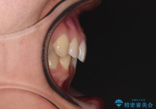 【モニター】前歯のデコボコとクロスバイト　インビザラインによる矯正治療の治療前