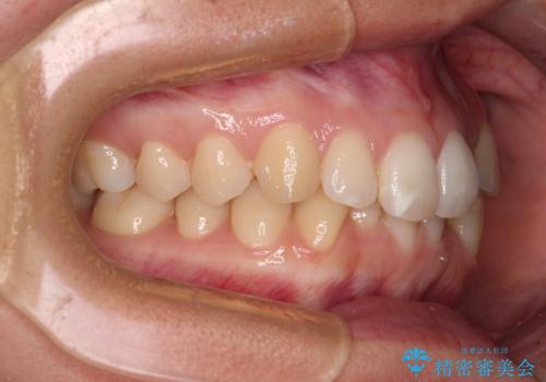 【モニター】前歯のデコボコとクロスバイト インビザラインによる矯正治療の治療前