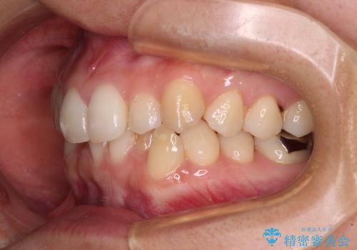 【モニター】前歯のデコボコとクロスバイト インビザラインによる矯正治療の治療前