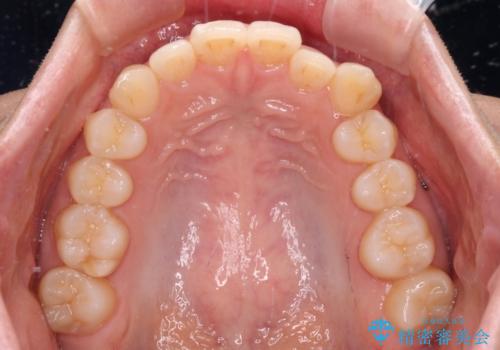 【モニター】前歯のデコボコとクロスバイト インビザラインによる矯正治療の治療前